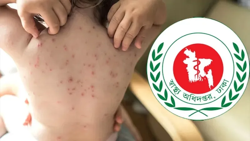 ২৪ ঘণ্টায় হাম উপসর্গে ২ জনের মৃত্যু, আক্রান্ত ৩৯১